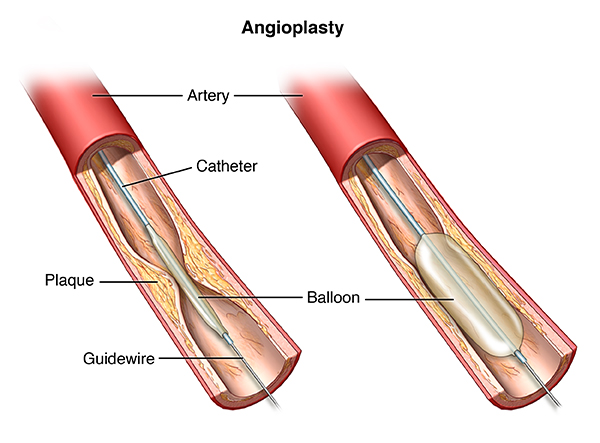 Angioplasty and Stent Placement for the Heart | Johns Hopkins Medicine