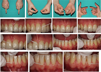 Diş İpi Nedir ve Nasıl Kullanılır ? Hangi Diş İpi Alınmalı ?
